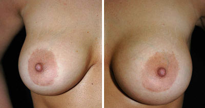 Breast_Implant_Deflation_01d