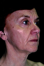facelift_before_01a